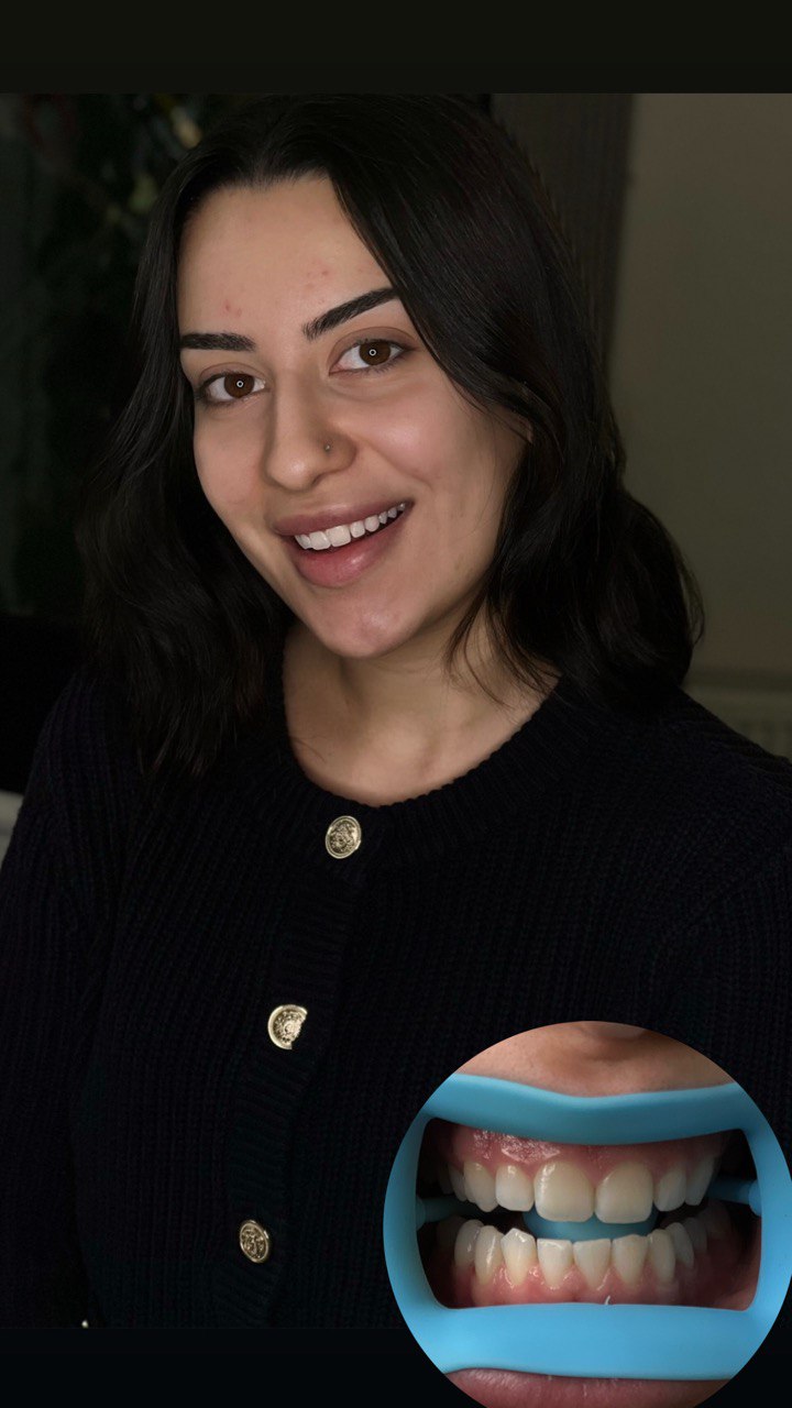 Zahnaufhellung Beratung